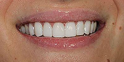 400x200-Alana-After-Mouth